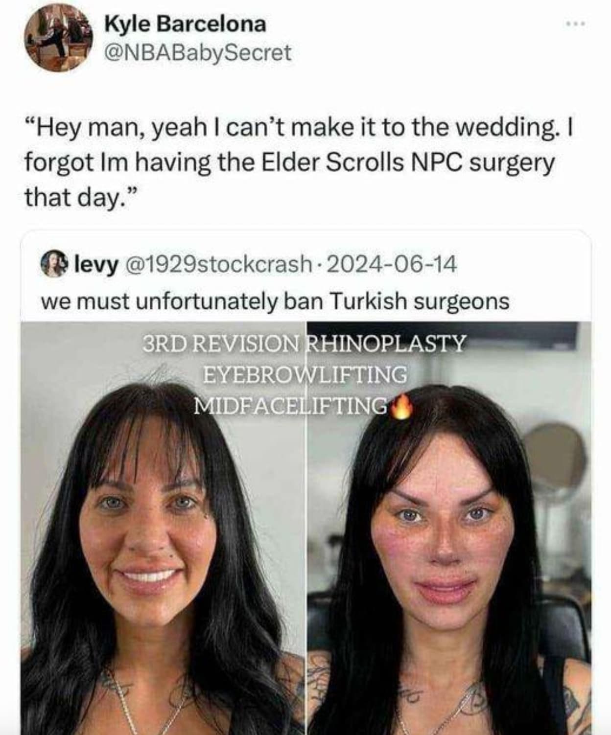 elder scrolls npc surgery turkey - Kyle Barcelona "Hey man, yeah I can't make it to the wedding. I forgot Im having the Elder Scrolls Npc surgery that day." levy we must unfortunately ban Turkish surgeons 3RD Revision Rhinoplasty Eyebrowlifting Midfacelif